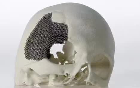 顱骨3D打印技術(shù)是什么？